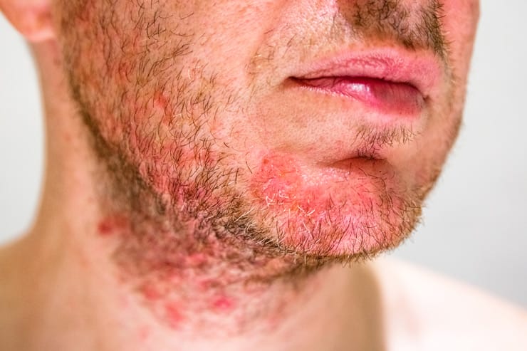 How To Prevent Razor Burn: The Secret to Smooth Shaving!